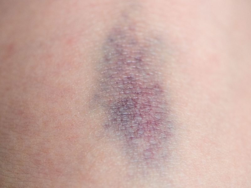 DPA Vorschau Bild für Artikel: Hämophilie / Große blaue Flecken? Dahinter kann eine Erkrankung stecken  
