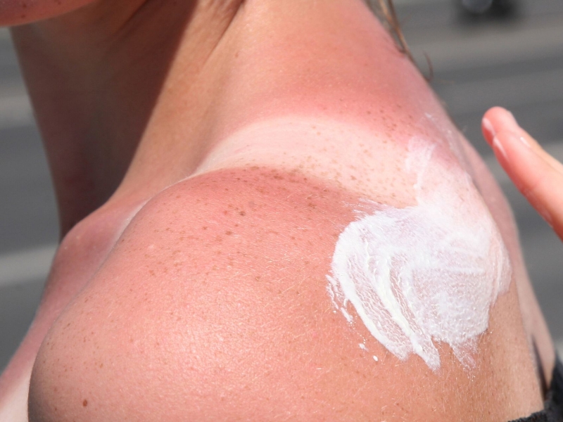 DPA Vorschau Bild für Artikel: Hautärztin gibt Tipps / Knallrot und mit Blasen: Was hilft bei starkem Sonnenbrand?  