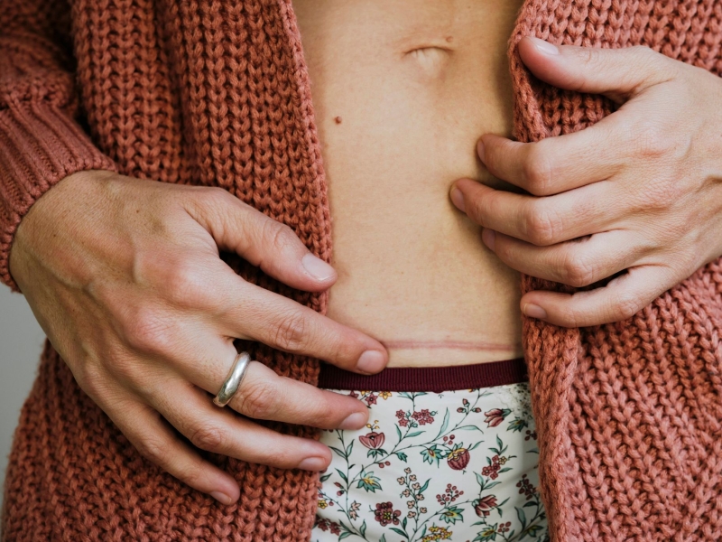 DPA Vorschau Bild für Artikel: Bitte nicht zu viel Spannung! / Worauf es bei der Pflege von Narben ankommt